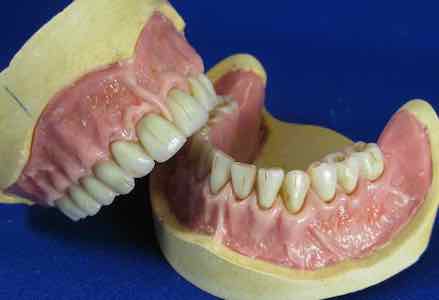 بررسی انواع چیدن دندان ها در پروتز متحرک
